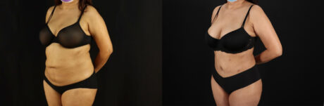 Tummy Tuck case #7469