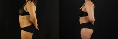 Tummy Tuck case #7469