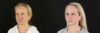 Submental Liposuction case #6950 slider thumbnail