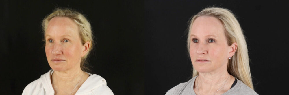 Renuvion RF Skin Tightening case #6928