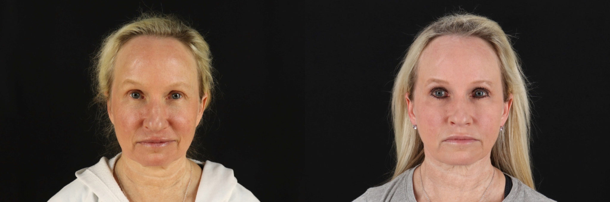 12010-89040-Renuvion-RF-Skin-Tightening-before-and-after-photo-by-Dr.-Erika-A.-Sato-in-Houston-TX