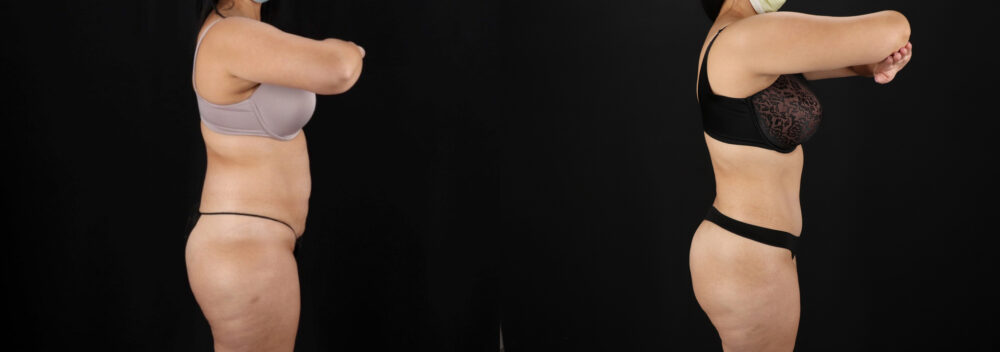 Tummy Tuck case #7462