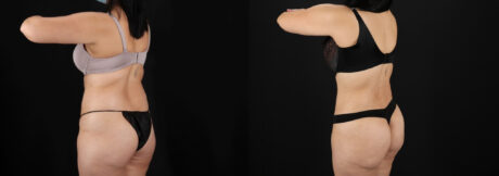 Tummy Tuck case #7462