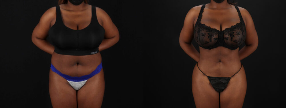 Brazilian Butt Lift case #5265