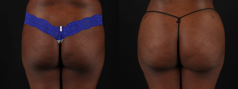 Brazilian Butt Lift case #5265