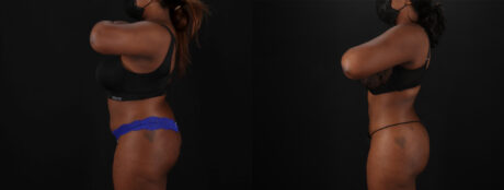 Brazilian Butt Lift case #5265