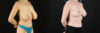 Breast Reduction case #7982 slider thumbnail