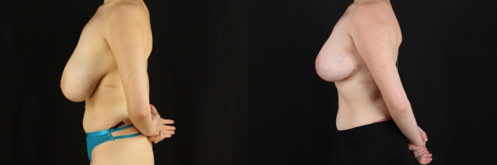 Breast Reduction case #7982