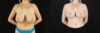 Breast Reduction case #7982 slider thumbnail
