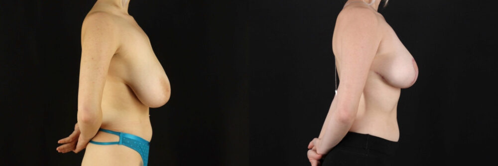 Breast Reduction case #7982