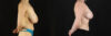 Breast Reduction case #7982 slider thumbnail
