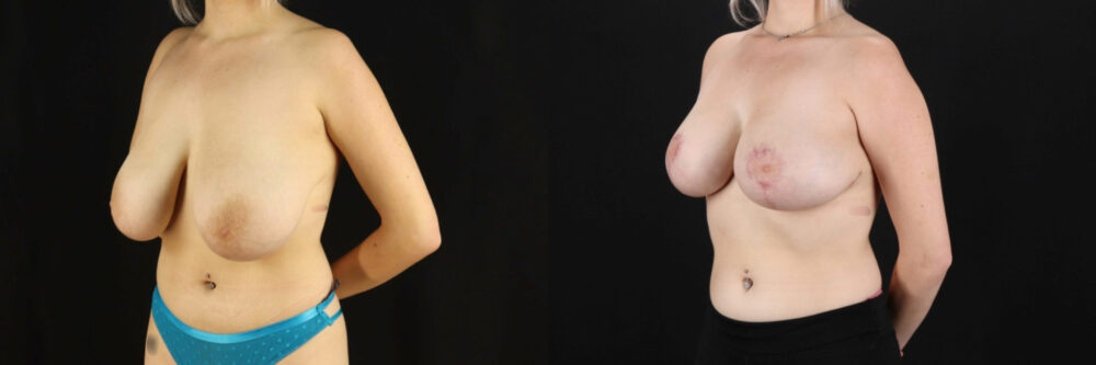 Breast Reduction case #7982