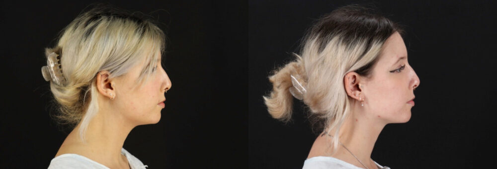 Submental Liposuction case #6951