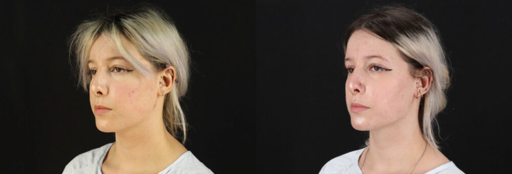 Submental Liposuction case #6951