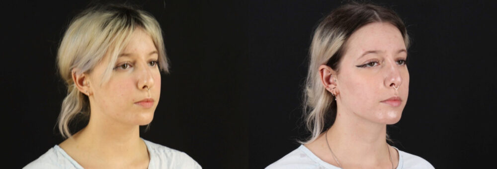 Submental Liposuction case #6951