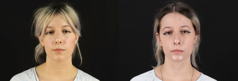 Submental Liposuction case #6951