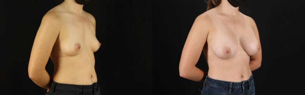 Breast Augmentation case #6364