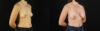 Breast Augmentation case #6364 slider thumbnail
