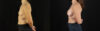Breast Augmentation case #6364 slider thumbnail