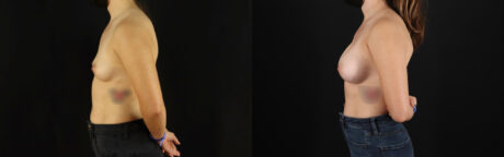 Breast Augmentation case #6364