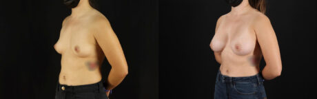 Breast Augmentation case #6364