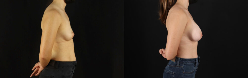 Breast Augmentation case #6364