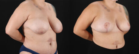 Mommy Makeover case #6523