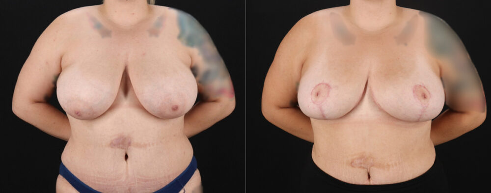 Mommy Makeover case #6523