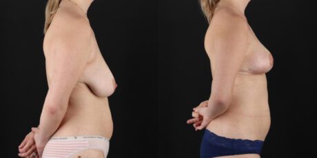 Breast Lift case #7768