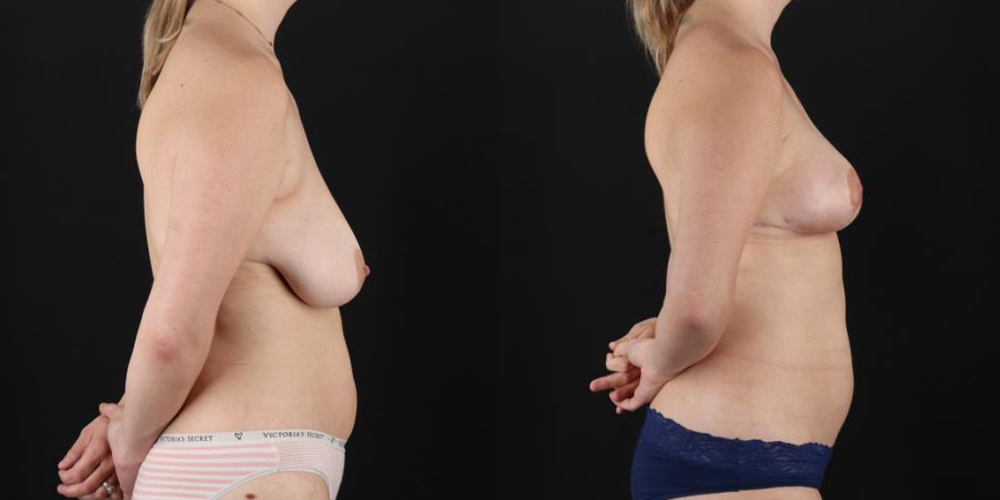 Breast Lift case #7768