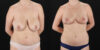 Breast Lift case #7768 slider thumbnail