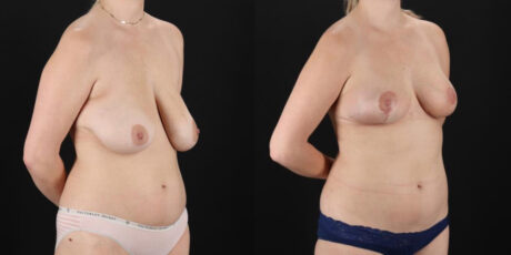 Breast Lift case #7768