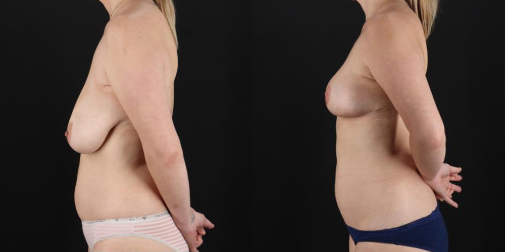Breast Lift case #7768