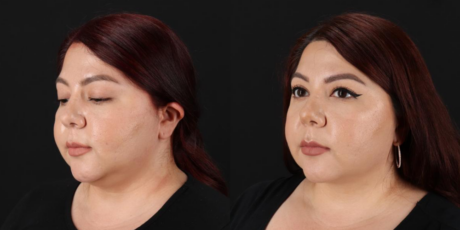 Submental Liposuction case #6952