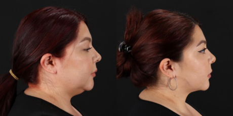 Submental Liposuction case #6952