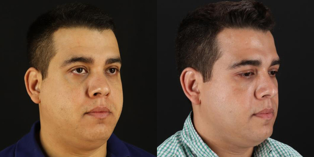 12653-26959-Filler-before-and-after-photo-by-Dr.-Erika-A.-Sato-in-Houston-TX