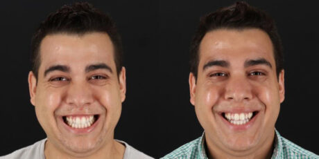 Botox® & Other Neuromodulators case #5038