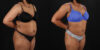 Liposuction case #6015 slider thumbnail