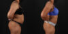 Liposuction case #6015 slider thumbnail