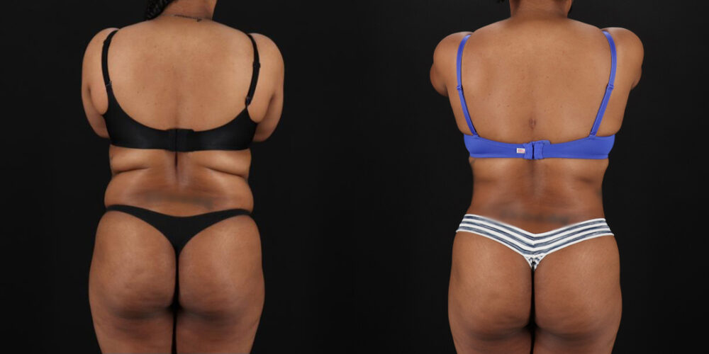 Liposuction case #6015