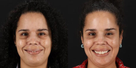 Botox® & Other Neuromodulators case #5034