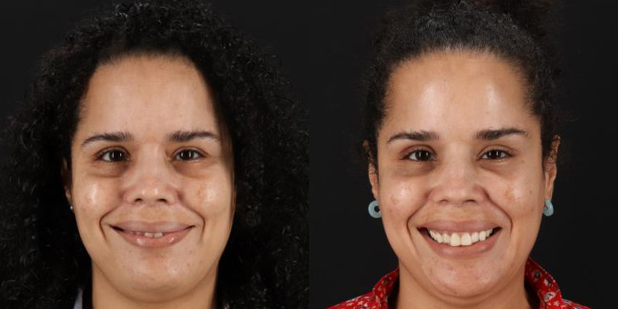 Botox® & Other Neuromodulators case #5034