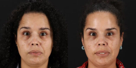 Botox® & Other Neuromodulators case #5034