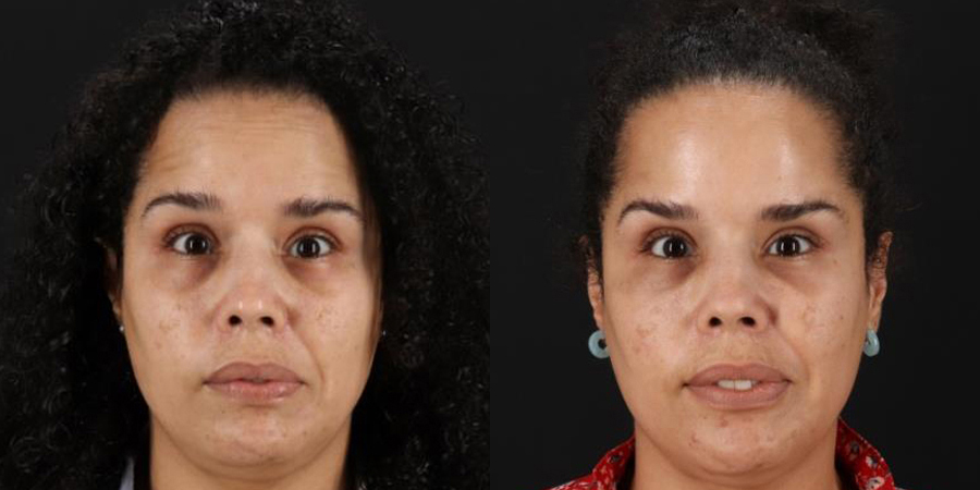 Botox® & Other Neuromodulators case #5034