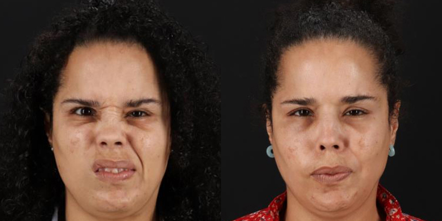 Botox® & Other Neuromodulators case #5034