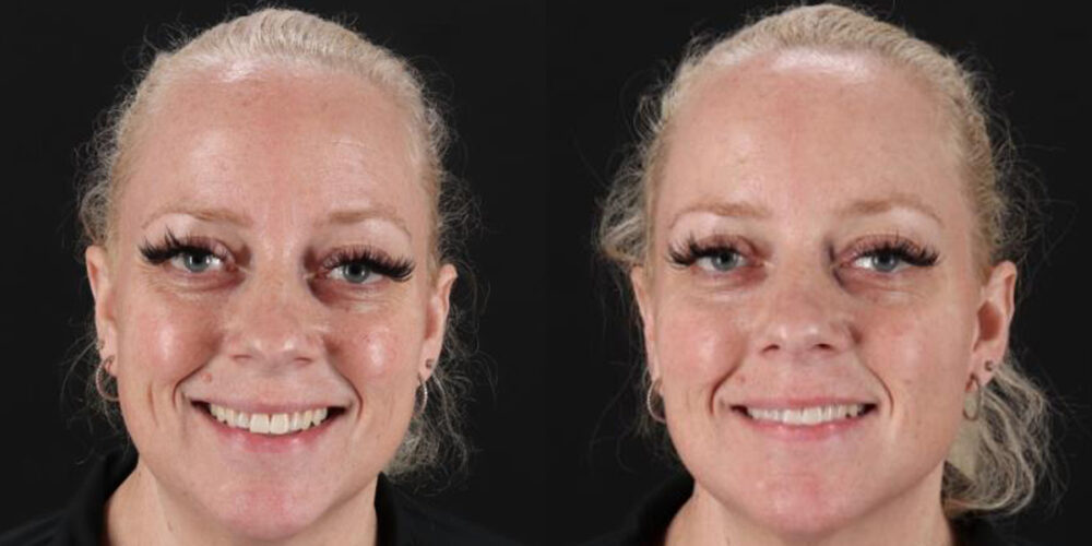 Botox® & Other Neuromodulators case #5030