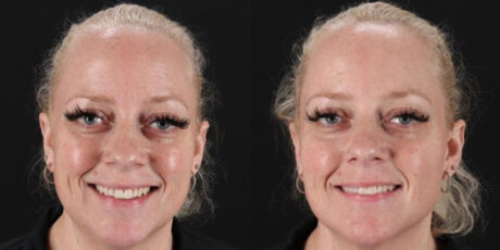 Botox® & Other Neuromodulators case #5030