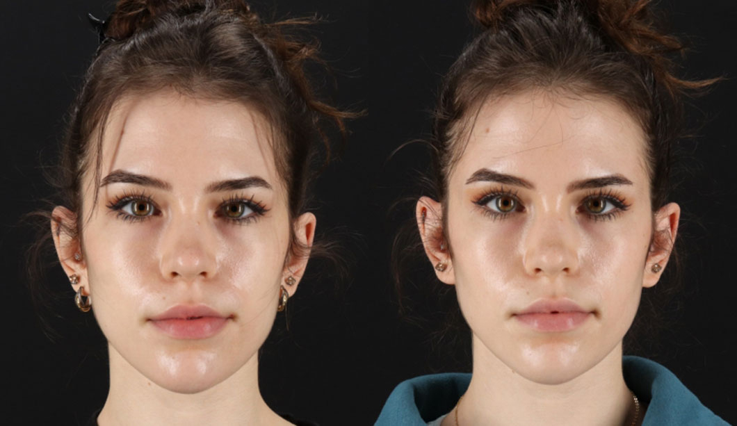 12678-86954-Filler-before-and-after-photo-by-Dr.-Erika-A.-Sato-in-Houston-TX