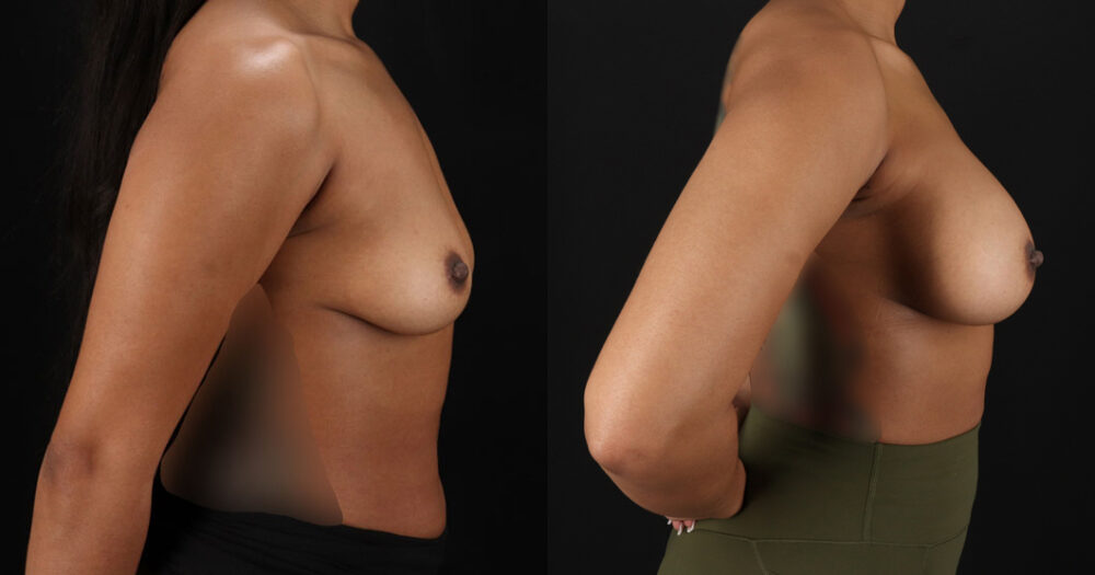 Breast Augmentation case #6390