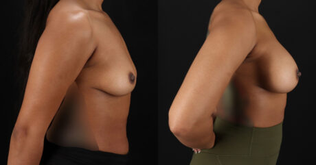 Breast Augmentation case #6390
